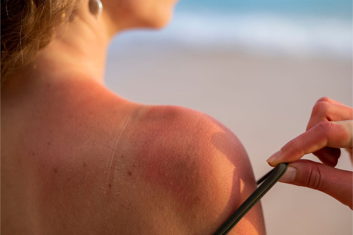 Fotoenvejecimiento de la piel: qué es, causas y cómo prevenirlo