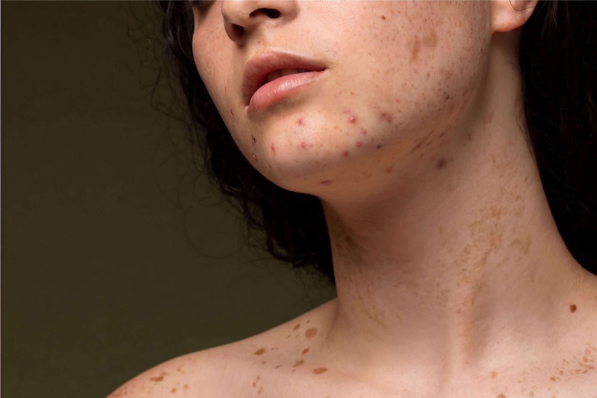 Cómo cuidar las manchas de la piel antes y durante el verano
